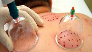 حجامت و فواید آن