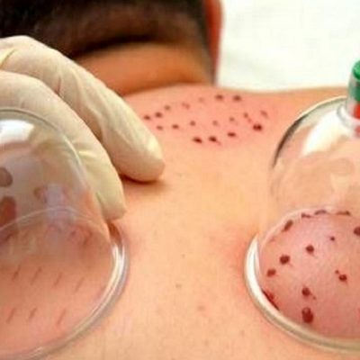 حجامت و فواید آن